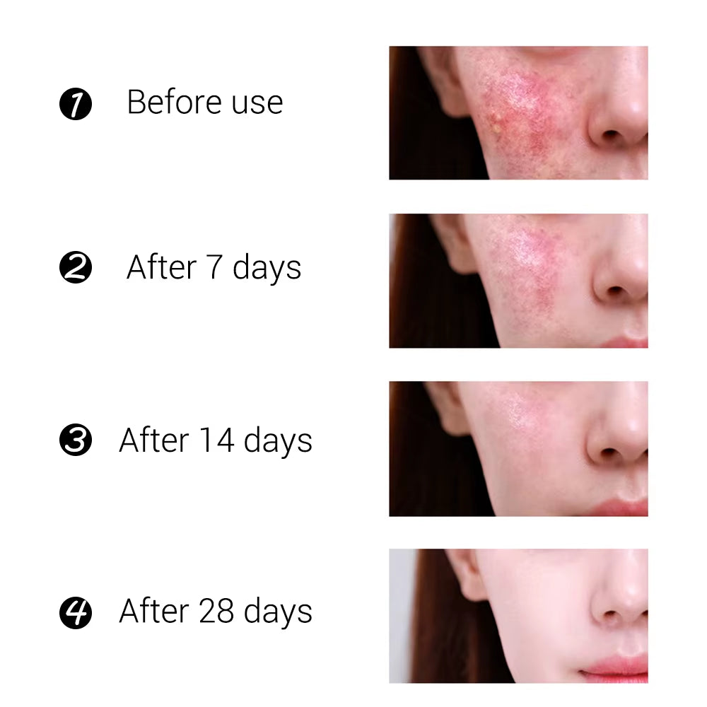 BREYLEE Tea Tree Acne Cream Acne Cream BL-28
