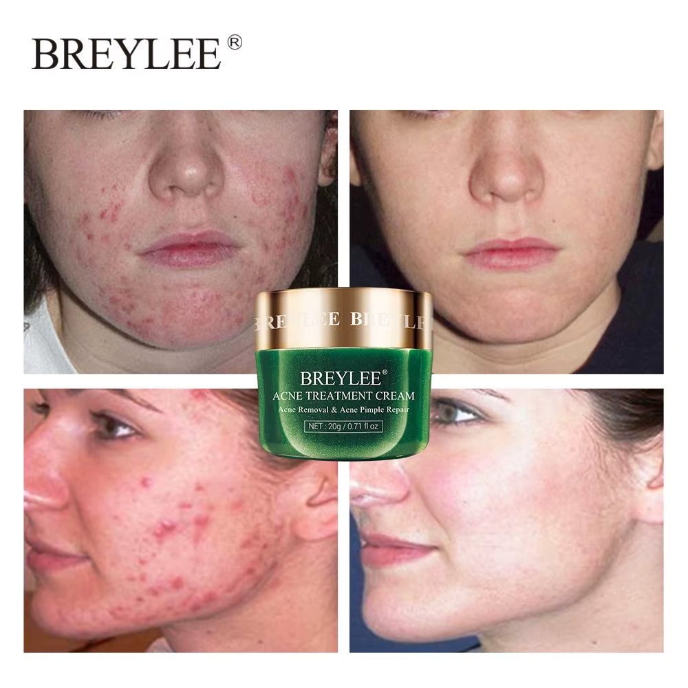 BREYLEE Tea Tree Acne Cream Acne Cream BL-28